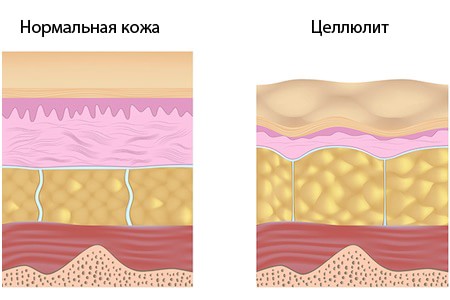Лечение целлюлита в ОН КЛИНИК