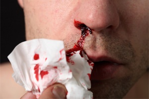 Носовое кровотечение